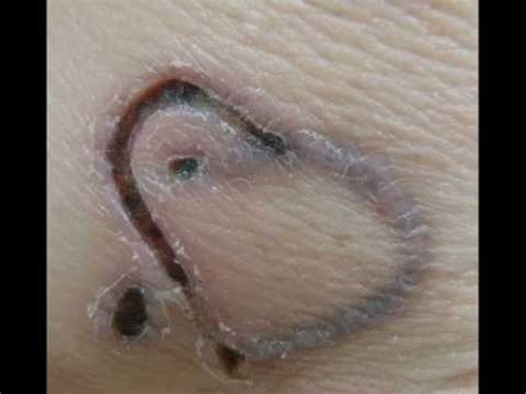 Mix 100 gm of salt in lemon juice and dip a cotton ball in this mixture. Laser Tattoo Removal - YouTube