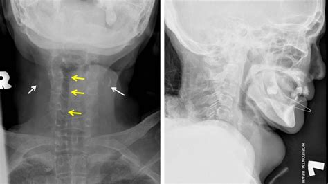 Anaplastic Thyroid Carcinoma Radiology Cases
