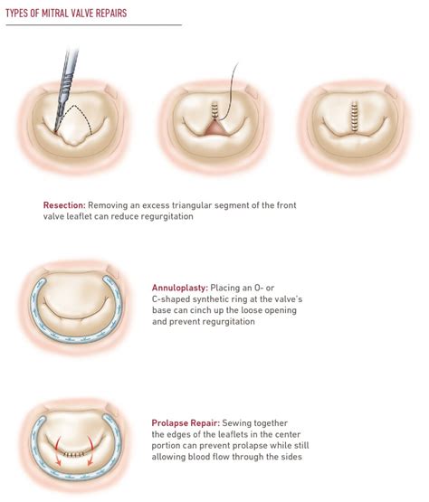 Mitral Valve Repair And Replacement Temple Health