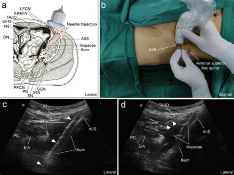 A Novel Anterior Approach For Ultrasound Guided Lumbar Plexus Combined