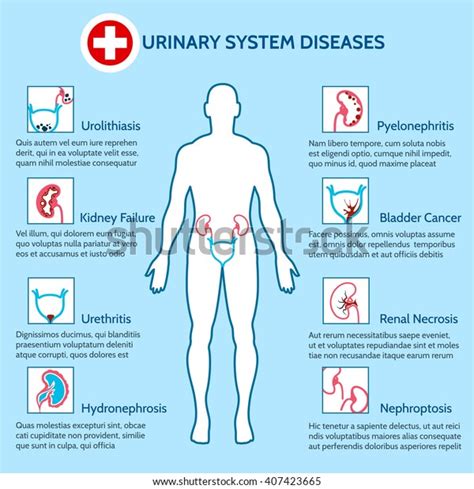 Medical Infographics Urinary System Diseases Vector Vetor Stock Livre De Direitos