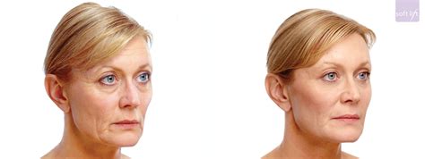 Botox Lakeshore Vein And Aesthetics Clinic Pre And Post Images