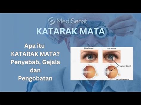 Pengobatan Katarak Mata Di Penang