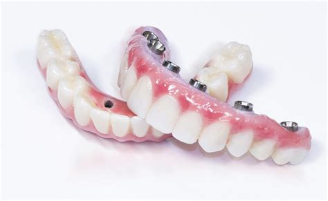 Dental Implants Full Mouth Dental Implants