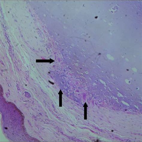 Photomicrograph Of A Case Of Idiopathic Scrotal Calcinosis Showing Download Scientific Diagram