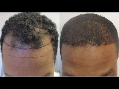 This hair growth stimulation shampoo uses a combination of thyme, rosemary, burdock root, white willow bark. Hair Regrowth for Men Naturally - YouTube