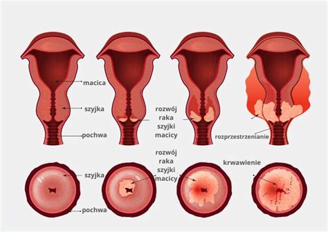 Hpv Diagnostyka I Zapobieganie Zaka Eniu Centrum Medyczne Tartaczna