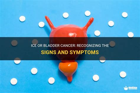 Ice Or Bladder Cancer Recognizing The Signs And Symptoms Medshun