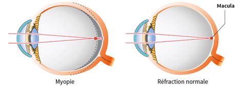Découvrez ce qu'est la myopie, les causes et les symptômes qui peuvent affecter votre vision de loin ainsi que des conseils utiles pour la corriger. Myopie Définition : Qu'est ce que la Myopie