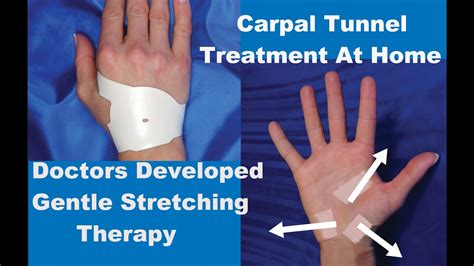 Carpal Tunnel Syndrome Causes Treatment Splint Surger
