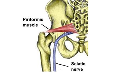 A few simple rules with the observance of technology exercises will allow you to quickly and efficiently work out the muscles of the arms, buttocks and lower back. Piriformis Syndrome - Symptoms, Treatment & Exercises