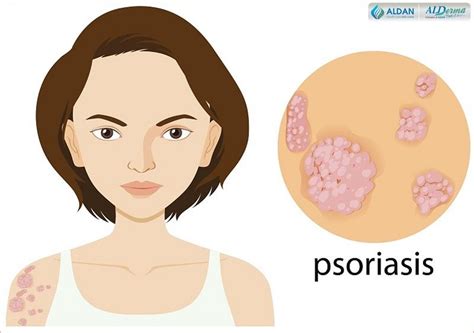 Best Ways To Prevent Psoriasis Psoriasis Flare Up Treatment