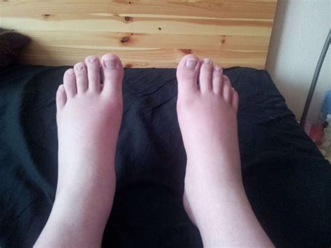 Swollen Ankles 10 Causes Of Swollen Ankles