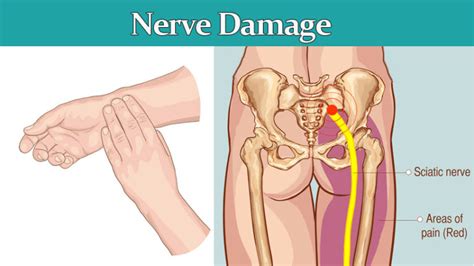 8 Symptoms Of Nerve Damage That May Be Serious Womenworking