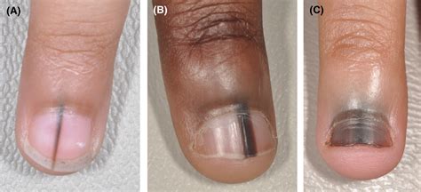 Nail Discoloration In Pediatric Skin Of Color Patients Bellet 2021