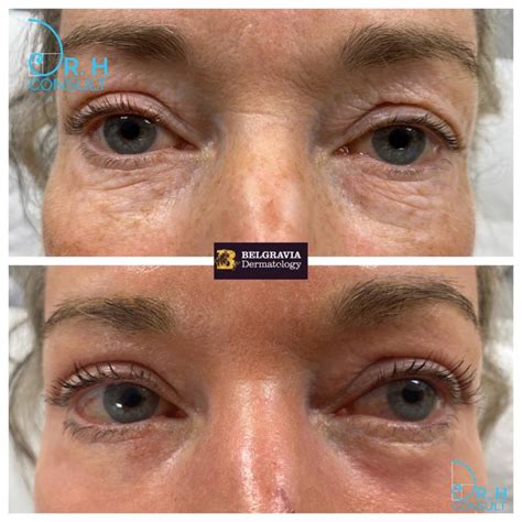 Laser Eyelid Tightening Surgery Treatment Dr H Consult
