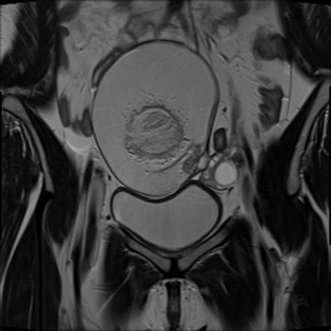 Mature Cystic Ovarian Teratoma Image Radiopaedia Org