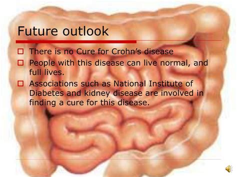 Ppt Crohns Disease Powerpoint Presentation Free Download Id4954621