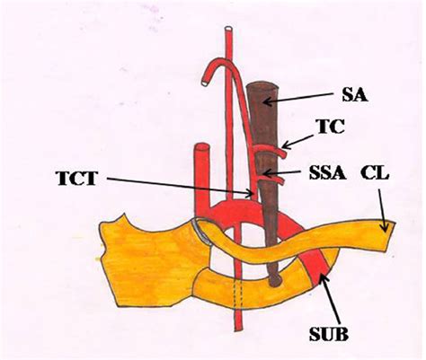 Showing Origin Of Suprascapular Artery From The Thyrocervical Trunk As