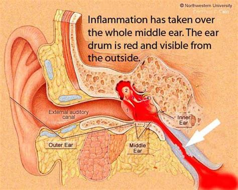 Otitis Media What Is Going On In Your Head Ear Infections Ear