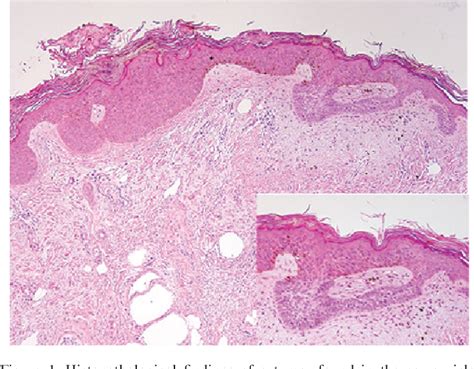 Basal Cell Carcinoma Arising Within A Seborrheic Keratosis With Respect My XXX Hot Girl