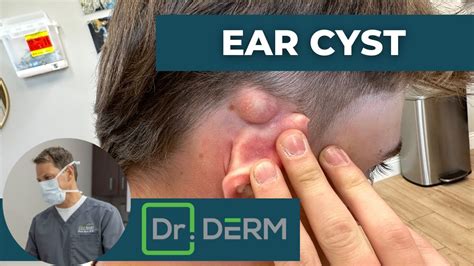 Ear Cyst Dr Derm Youtube