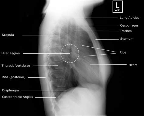 Lateral View Chest X Ray Anatomy Anatomy Structure Sexiz Pix
