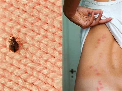 How To Identify Common Bug Bites And Treat Them Properly Businessinsider India