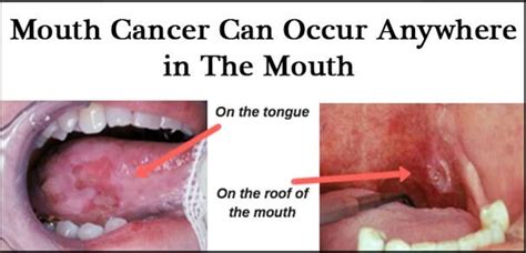 In the early stages, mouth cancer rarely causes any pain. What is the cost of the treatment of mouth cancer in India ...