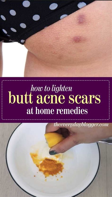 Pin By Little Angel👼🏻 On Natural Scar Remedy Butt Acne Natural Acne