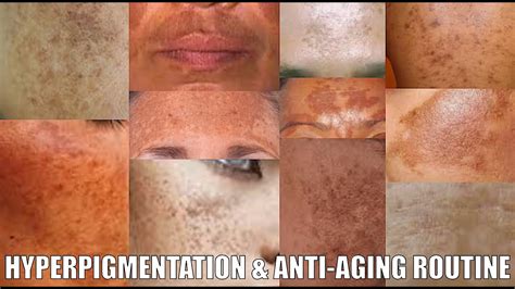 How To Get Rid Of Hyperpigmentation Full Skincare Routine Youtube