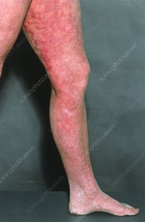 Livedo Reticularis On A Patients Leg Stock Image M2000092