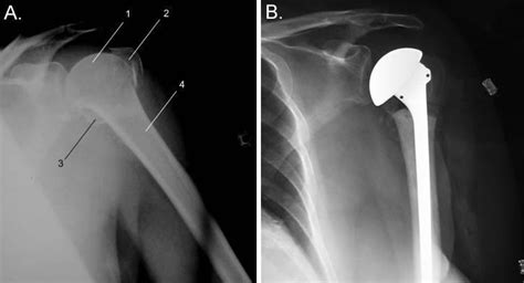 Proximal Humerus Fractures Boise Shoulder Injuries Boise Eagle Id