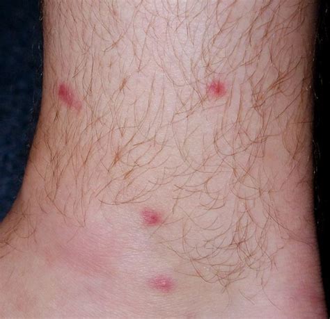 Red Dots On Legs Pictures Symptoms Causes Treatment