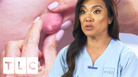 Its Like A Rock” Dr Lee Removes A Rare Hard Cyst Dr Pimple Popper Youtube