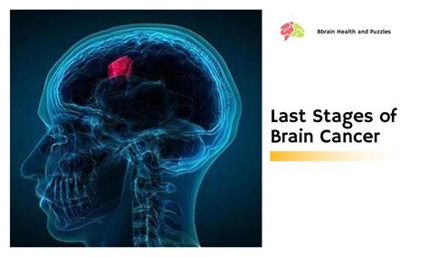 Last Stages Of Brain Cancer More Than Just A Headache Brain Health