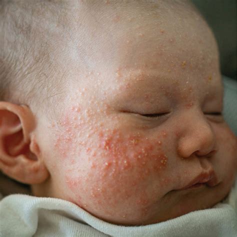 Baby Acne Causes And Treatment Daisy First Aid