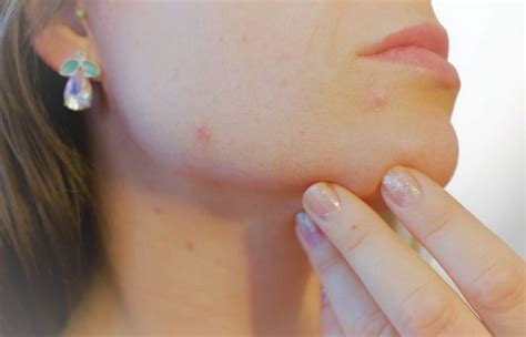 Roacután Qué es dosis efectos Medicamento remedio para el acné