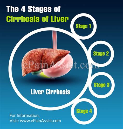 The 4 Stages Of Cirrhosis Of Liver Cirrhosis Heal Liver Liver