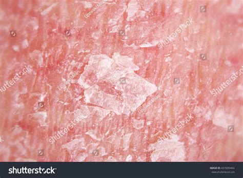 Psoriasis Vulgaris Psoriatic Skin Disease Skin Stock Photo 497699404