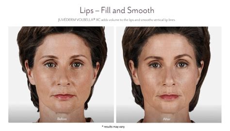 Dermal Fillers Fort Worth Restore Youthful Contours