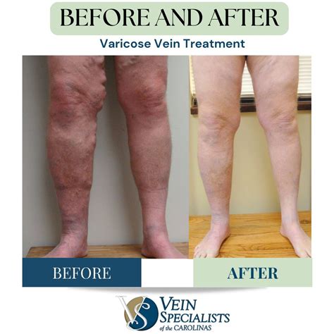 Comprehensive Vein Care From Consultation To Recovery Vein