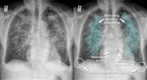 Chest X Ray Cardiac Disease Pulmonary Oedema Alveolar