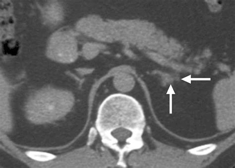 Ct And Mr Imaging Of The Adrenal Glands In Acth Independent Cushing