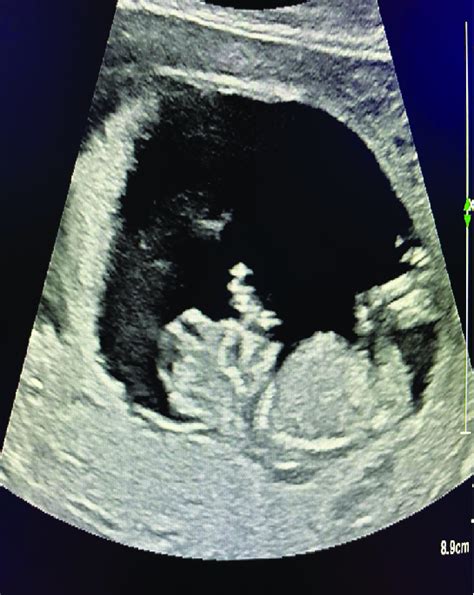 Fetal Anencephaly Ultrasound Encephalic Deficit Depiction Download Scientific Diagram