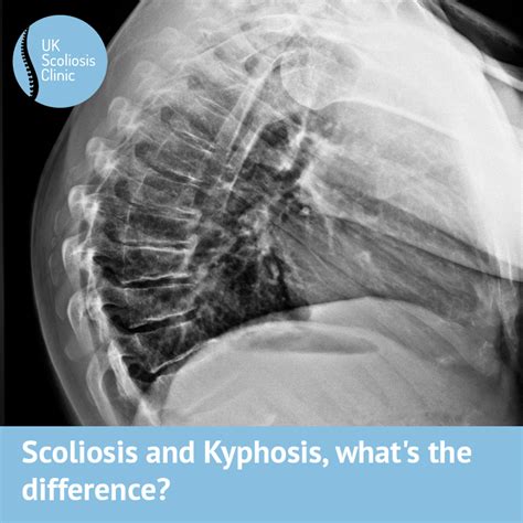 Scoliosis And Kyphosis Whats The Difference Scoliosis Clinic Uk Treating Scoliosis