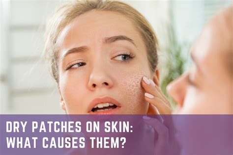 Dry Patches On Skin What Causes Them Theraderm Clinical Skin Care