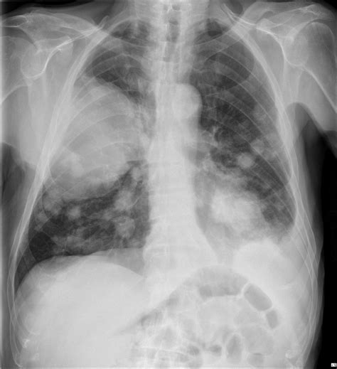 Advanced Metastatic Lung Cancer Image
