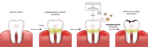Tooth Decay Formation Hoyt Dental Murrieta And Temecula Dentist