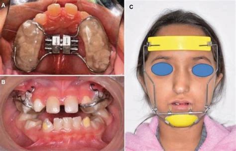 Full Article Developing Class Iii Malocclusions Challenges And Solutions